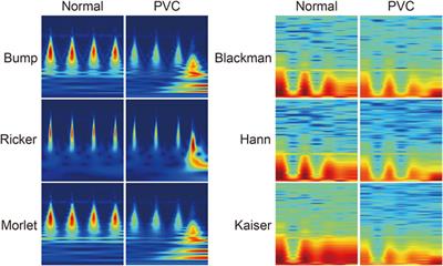 Comparative study of time-frequency transformation methods for ECG signal classification